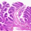 6A1 Olivary Hyperplasia (Case 4) Cerebellar hemorrhage-infarct