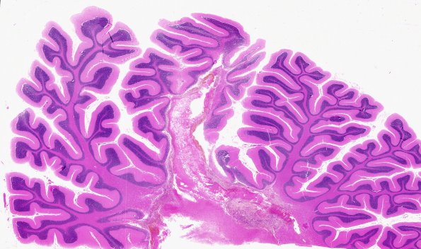 6A1 Olivary Hyperplasia (Case 4) Cerebellar hemorrhage-infarct