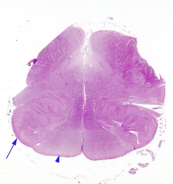 6A2 Olivary Hyperplasia (Case 4, N10) H&E 1