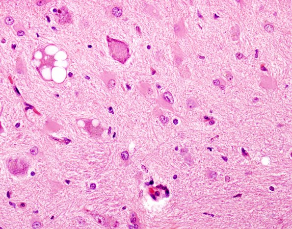 6A3 Olivary Hyperplasia (Case 4, N10) H&E 6