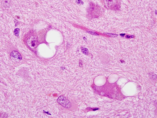 6A4 Olivary Hyperplasia (Case 4, N10) H&E 4