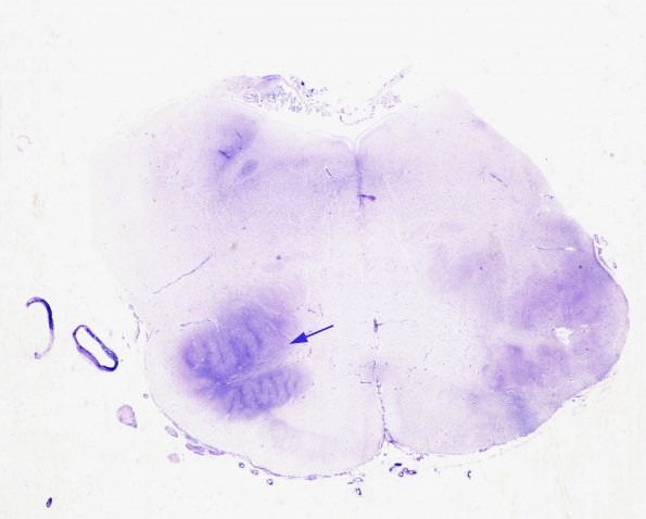 6B Olivary Hyperplasia (Case 4, N10) 1 Holtzer 1