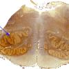 6C Olivary Hyperplasia (Case 4, N10) 1 Bielschowsky 1