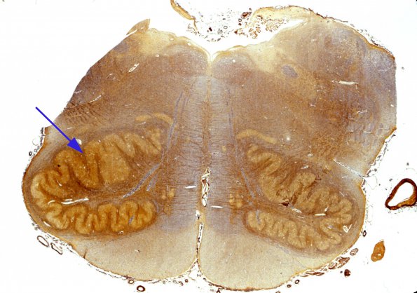 6C Olivary Hyperplasia (Case 4, N10) 1 Bielschowsky 1