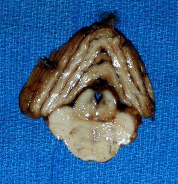 7A1 Olivary hyperplasia, ION CTT interruption (Case 8) Pons gross