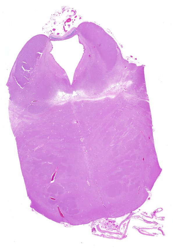 7A2 Olivary hyperplasia, ION CTT interruption (Case 8)