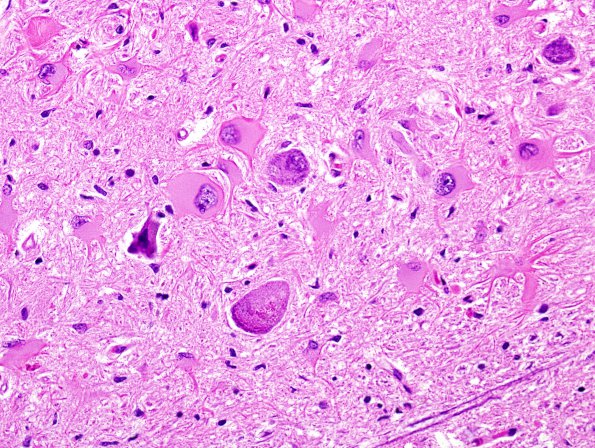 8 Olivary hyperplasia, ION CTT interruption (ipsilat Case 9) H&E 5