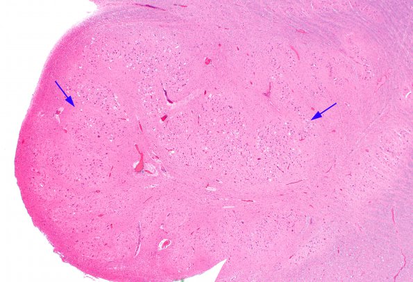 9A1 Olivary hyperplasia (Case 11) N8 H&E 2A