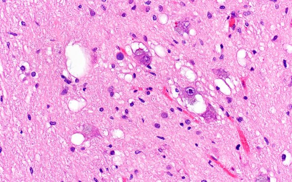 9A2 Olivary hyperplasia (Case 11) N8 H&E 5