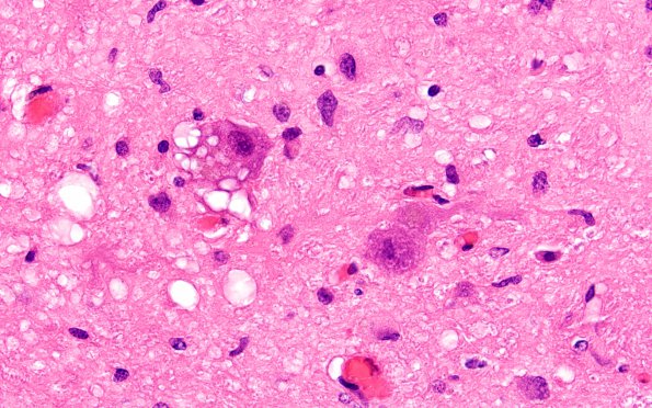 9A3 Olivary hyperplasia (Case 11) N8 H&E 7