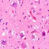 9A4 Olivary hyperplasia (Case 11) N8 H&E 9