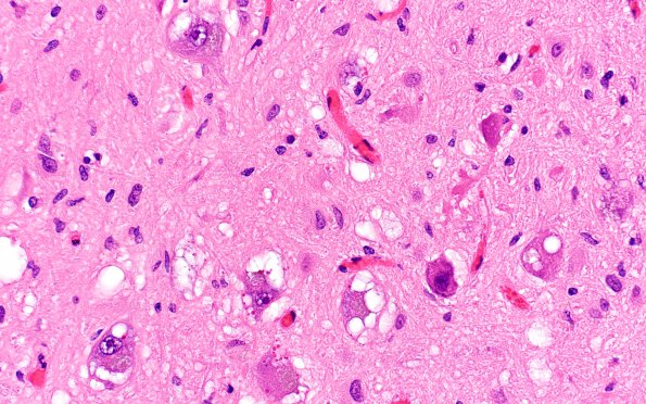 9A4 Olivary hyperplasia (Case 11) N8 H&E 9