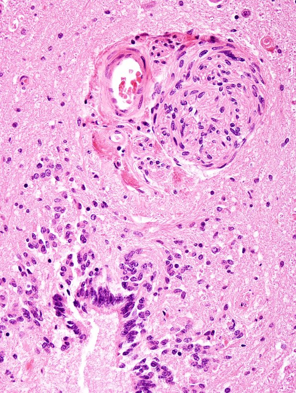 3 Schwannosis (Case 1) H&E 1