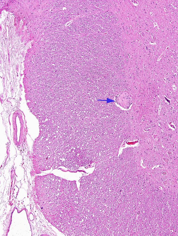 4A1 Schwannosis (Case 3) rostral spinal cord H&E 2