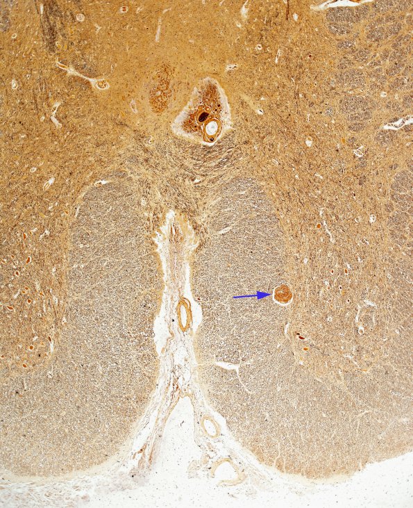 4B1 Schwannosis (Case 3) rostral cord Biels 1A