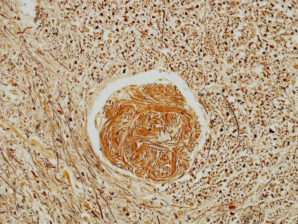 4B2 Schwannosis (Case 3) rostral cord Biels 1