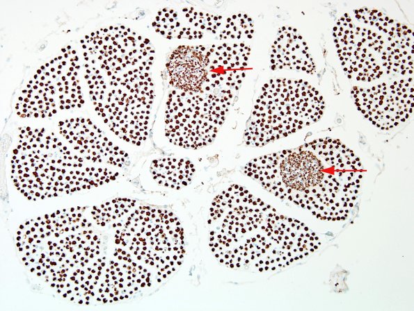 5C1 Schwannosis (Case 4) NF 1