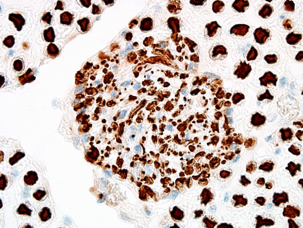 5C3 Schwannosis (Case 4) NF 100X