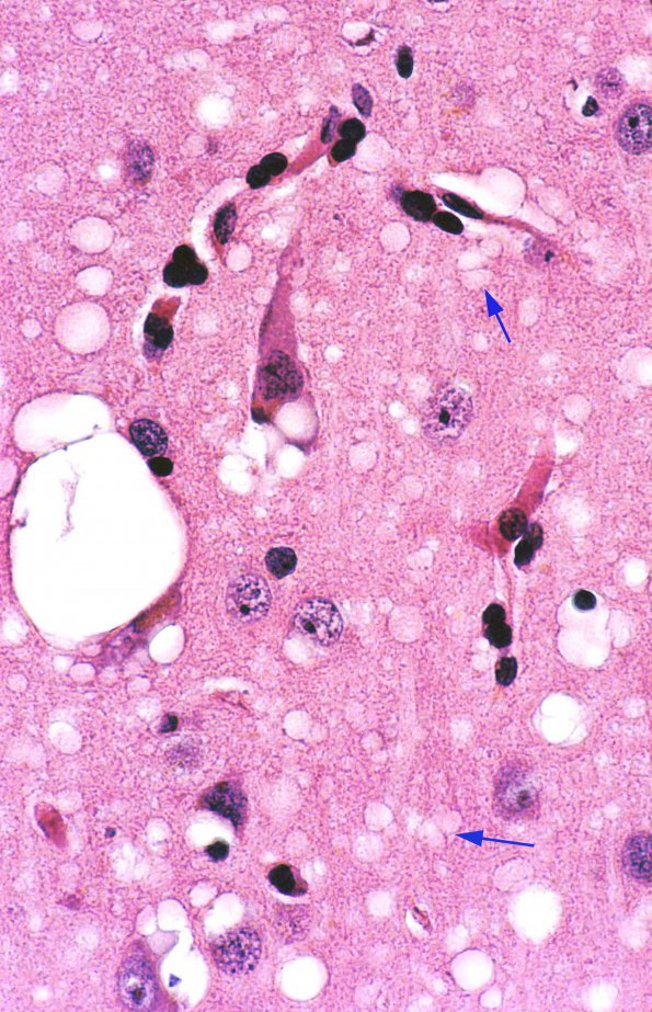 2 Spongiform change, CJD 2