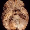 1A1 Superficial Siderosis (Case 1) R vs L 1