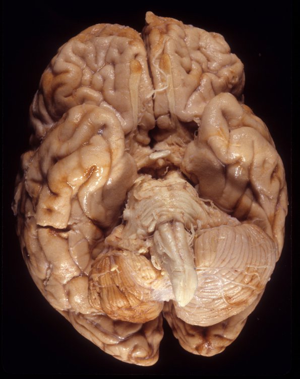 1A1 Superficial Siderosis (Case 1) R vs L 1