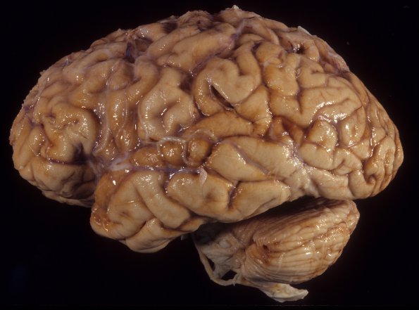 1A2 Superficial Siderosis (Case 1) 3