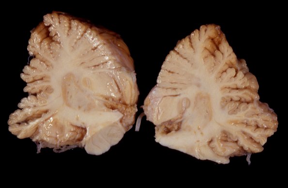 1A3 Superficial Siderosis (Case 1) 2