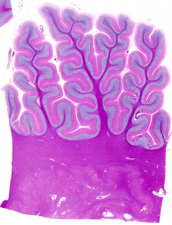 1B1 Superficial Siderosis (Case 1) Cerebellum L side whole mount