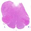 1B10 Superficial Siderosis (Case 1) Medulla H&E 1