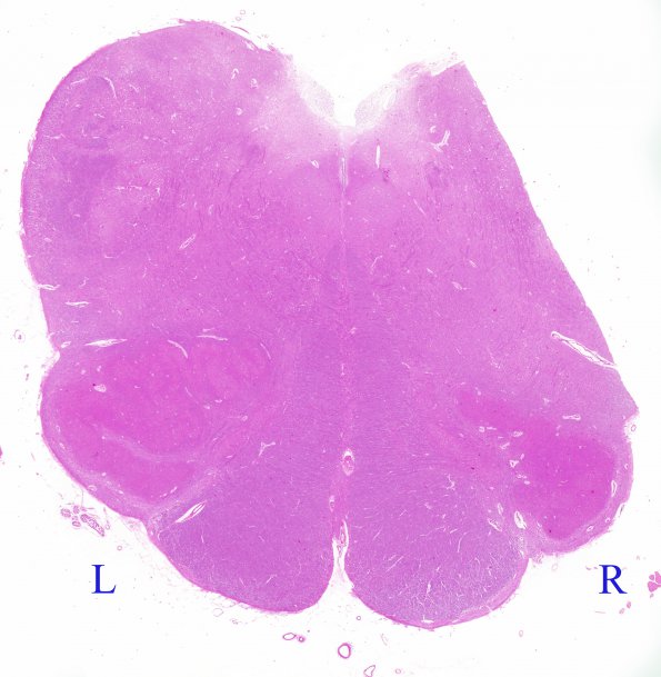 1B10 Superficial Siderosis (Case 1) Medulla H&E 1