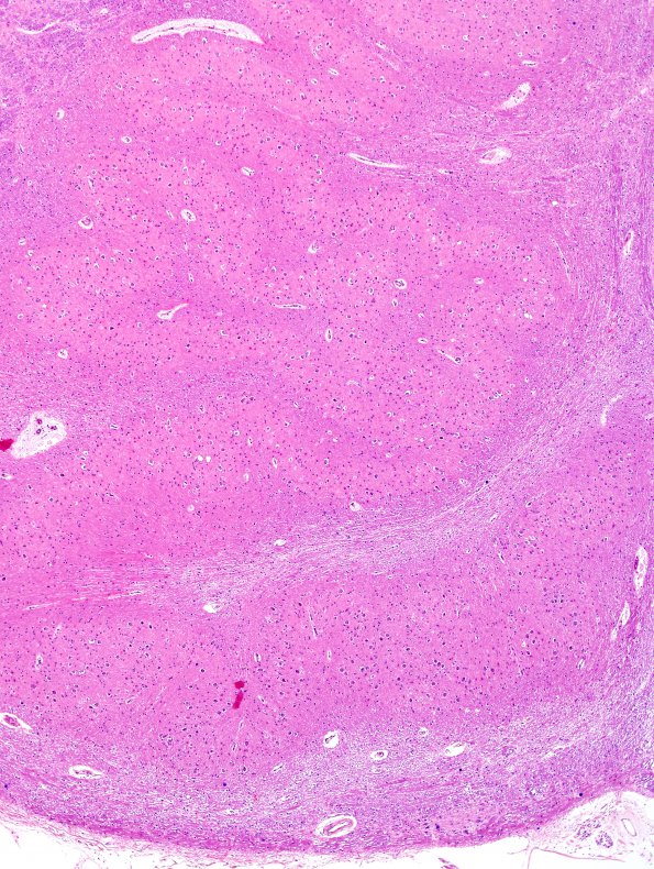 1B11 Superficial Siderosis (Case 1) (ION) L side H&E 4X