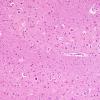 1B12 Superficial Siderosis (Case 1) (ION) L side H&E 20X