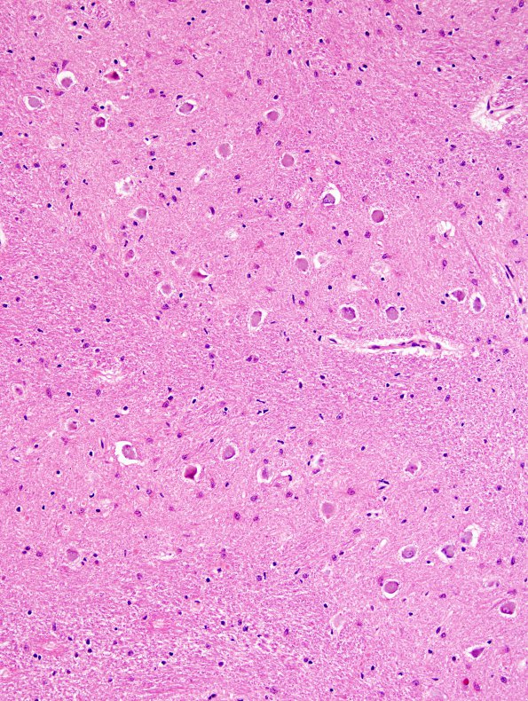 1B12 Superficial Siderosis (Case 1) (ION) L side H&E 20X