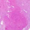 1B13 Superficial Siderosis (Case 1) (ION) R side H&E 4X