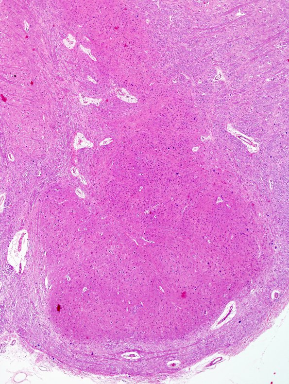 1B13 Superficial Siderosis (Case 1) (ION) R side H&E 4X