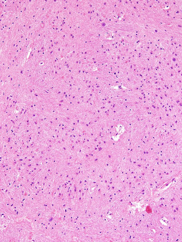 1B14 Superficial Siderosis (Case 1) (ION) R side H&E 20X