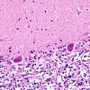 1B4 Superficial Siderosis (Case 1) Cerebellum L side H&E 5