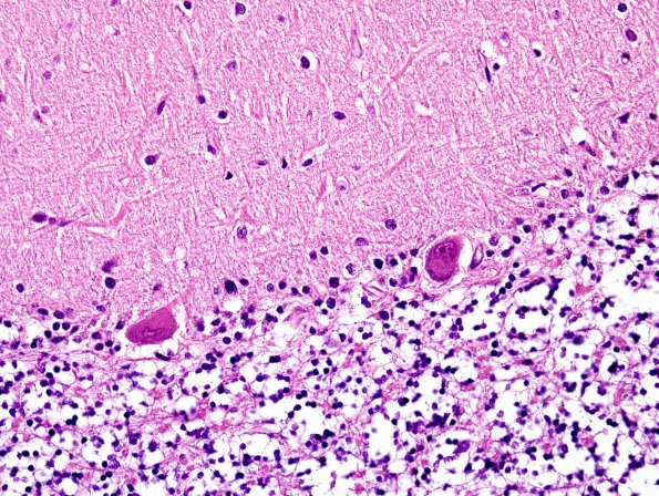 1B4 Superficial Siderosis (Case 1) Cerebellum L side H&E 5