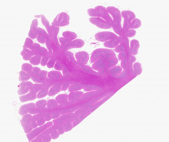 1B5 Superficial Siderosis (Case 1) Cerebellum R side H&E whole mount