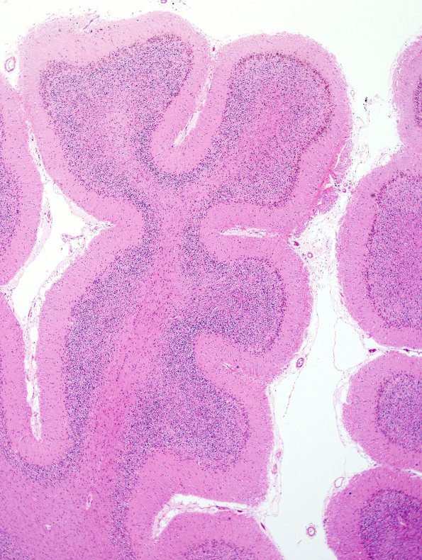 1B6 Superficial Siderosis (Case 1) Cerebellum R side H&E 2