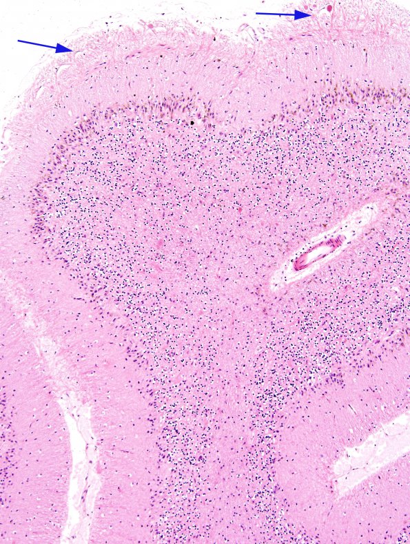 1B7 Superficial Siderosis (Case 1) Cerebellum R side H&E 3