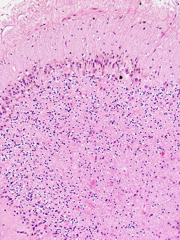 1B8 Superficial Siderosis (Case 1) Cerebellum R side H&E 4