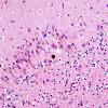 1B9 Superficial Siderosis (Case 1) Cerebellum R side H&E 5