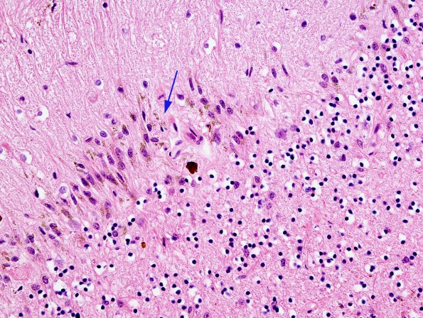 1B9 Superficial Siderosis (Case 1) Cerebellum R side H&E 5