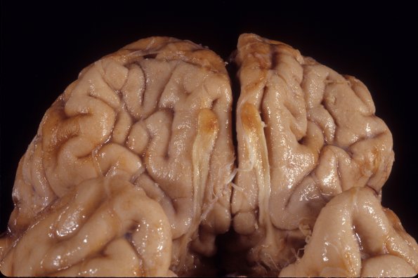 1C1 Superficial Siderosis (Case 1) 1