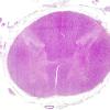 2A1 Superficial siderosis (AANP 2007-Case 1) H&E stain