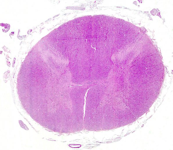 2A1 Superficial siderosis (AANP 2007-Case 1) H&E stain