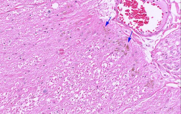 2A2 Superficial Siderosis (AANP2007-Case 1) H&E 2 20X