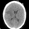 11A1 CT without contrast 1  (Case 11) - Copy