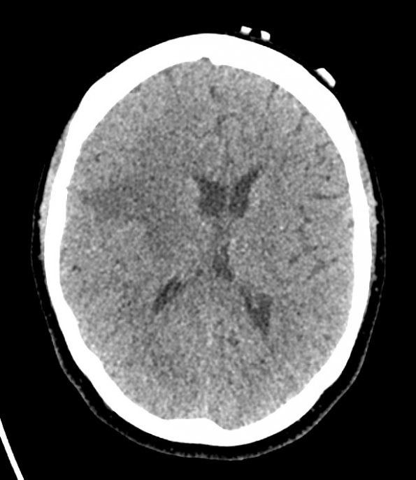 11A1 CT without contrast 1  (Case 11) - Copy